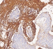 Collagen I Antibody / Extracellular Matrix Protein Human Liver Cancer IHC. Immunohistochemical staining of FFPE human liver cancer tissue using Collagen I Antibody / Extracellular Matrix Protein. Collagen I expression is observed predominantly within the stromal extracellular matrix surrounding tumor nests, consistent with its role in maintaining tissue architecture and supporting the desmoplastic tumor microenvironment. Heat-induced epitope retrieval was performed by boiling tissue sections in pH 8 EDTA for 20 minutes followed by cooling prior to immunostaining.