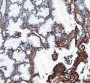 Collagen I Antibody / Extracellular Matrix Protein Human Lung Adenocarcinoma IHC. Immunohistochemical staining of FFPE human lung adenocarcinoma tissue using Collagen I Antibody / Extracellular Matrix Protein. Collagen I expression is observed predominantly within the stromal extracellular matrix surrounding malignant glands, consistent with its role in maintaining tissue architecture and contributing to the desmoplastic tumor microenvironment. Heat-induced epitope retrieval was performed by boiling tissue sections in pH 8 EDTA for 20 minutes followed by cooling prior to immunostaining.