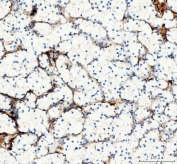 Collagen I Antibody / Extracellular Matrix Protein Human Renal Cell Carcinoma IHC. Immunohistochemical staining of FFPE human renal cell carcinoma tissue using Collagen I Antibody / Extracellular Matrix Protein. Collagen I expression is observed predominantly within the stromal extracellular matrix surrounding tumor nests and fibrous septa, consistent with its role in maintaining connective tissue architecture and contributing to the renal tumor microenvironment. Heat-induced epitope retrieval was performed by boiling tissue sections in pH 8 EDTA for 20 minutes followed by cooling prior to immunostaining.