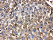 Catalase Antibody / Antioxidant Enzyme Antibody Human Liver Cancer IHC. Immunohistochemical staining of FFPE human liver cancer tissue using Catalase Antibody / Antioxidant Enzyme Antibody. Catalase expression is detected predominantly within the cytoplasm of tumor cells, consistent with its localization in peroxisomes and its role in detoxifying hydrogen peroxide to protect cells from oxidative stress. Heat-induced epitope retrieval was performed by boiling tissue sections in pH 6, 10 mM citrate buffer for 20 minutes and allowing them to cool prior to immunostaining.