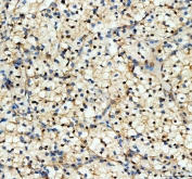 YAP1 Antibody Renal Clear Cell Carcinoma IHC. Immunohistochemical staining of FFPE human renal clear cell carcinoma (RNCC) tissue demonstrates YAP1 expression using a YAP1 antibody. YAP1, also known as Yes Associated Protein 1, is a transcriptional coactivator and key Hippo pathway effector involved in cell proliferation, survival, and tumor progression. Predominantly nuclear and cytoplasmic staining is observed in neoplastic cells, consistent with active YAP1 signaling reported in renal cell carcinoma and other malignancies. Heat induced epitope retrieval was performed by boiling tissue sections in pH8 EDTA buffer for 20 minutes followed by cooling prior to staining. These findings support the utility of YAP1 Antibody for investigating Hippo pathway activity and oncogenic signaling in human renal cancers.