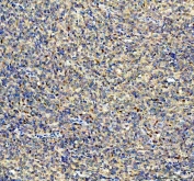 YAP1 Antibody Diffuse Large B Cell Lymphoma IHC. Immunohistochemical staining of FFPE human diffuse large B cell lymphoma of the intestine demonstrates YAP1 expression using a YAP1 antibody. YAP1, also known as Yes Associated Protein 1, is a transcriptional coactivator and major Hippo pathway effector that regulates cell proliferation, survival, and differentiation. Tumor cells show nuclear and cytoplasmic staining consistent with activated YAP1 signaling, which has been implicated in lymphoma progression and therapeutic resistance. Heat induced epitope retrieval was performed by boiling tissue sections in pH8 EDTA buffer for 20 minutes followed by cooling prior to staining. These findings support the use of YAP1 Antibody for studying Hippo pathway activity and oncogenic signaling in hematologic malignancies.