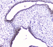 IHC staining of FFPE human breast cancer with Cdk6 antibody at 1ug/ml. HIER: boil tissue sections in pH6, 10mM citrate buffer, for 10-20 min followed by cooling at RT for 20 min.