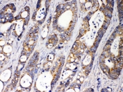 IHC testing of FFPE human intestinal cancer tissue with ACAA2 antibody at 1ug/ml. HIER: steam sections in pH6 citrate buffer for 20 min.