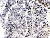 E2F4 Antibody Intestine Cancer IHC. Immunohistochemistry testing of FFPE human intestinal cancer tissue with E2F4 antibody at 1ug/ml. HIER: steam section in pH6 citrate buffer for 20 min.