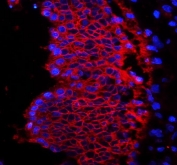 EpCAM Antibody Rectal Cancer IF. Immunofluorescent staining of human rectal cancer tissue with EpCAM antibody (red) and DAPI (blue). HIER: steam sections in pH6 citrate buffer for 20 min.