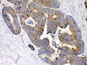 IHC testing of FFPE human intestine cancer tissue with MPS1 antibody at 1ug/ml. HIER: steam section in pH6 citrate buffer for 20 min.