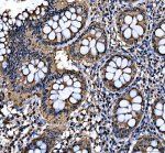 SAFB Antibody Human Colon Cancer IHC. Immunohistochemical staining of FFPE human colon cancer tissue demonstrated moderate to strong SAFB expression with predominantly nuclear staining in neoplastic epithelial cells and weaker staining in the surrounding stroma. Heat-induced epitope retrieval was performed in pH8 EDTA buffer before staining with the primary antibody and HRP-DAB detection. The nuclear localization is consistent with the established role of SAFB as a Scaffold Attachment Factor involved in chromatin organization, transcriptional regulation and RNA processing. This SAFB Antibody, a Scaffold Attachment Factor Antibody, is suitable for immunohistochemical studies of nuclear protein expression in cancer and gene regulation research.