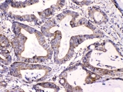 IHC testing of FFPE human intestinal cancer tissue with Calpastatin antibody at 1ug/ml. HIER: steam section in pH6 citrate buffer for 20 min.