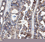 Immunohistochemical staining of FFPE human colorectal adenocarcinoma tissue with MUT antibody, HRP-secondary and DAB substrate. HIER: boil tissue sections in pH8 EDTA for 20 min and allow to cool before testing.