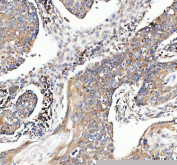 Immunohistochemical staining of FFPE human esophageal squamous carcinoma tissue with MUT antibody, HRP-secondary and DAB substrate. HIER: boil tissue sections in pH8 EDTA for 20 min and allow to cool before testing.