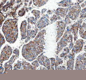 Immunohistochemical staining of FFPE human liver cancer tissue with MUT antibody, HRP-secondary and DAB substrate. HIER: boil tissue sections in pH8 EDTA for 20 min and allow to cool before testing.