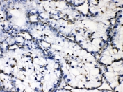 IHC testing of FFPE human liver cancer tissue with GAA antibody at 1ug/ml. HIER: steam section in pH6 citrate buffer for 20 min.