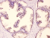 IHC testing of FFPE human prostate cancer tissue with GAA antibody at 1ug/ml. HIER: steam section in pH6 citrate buffer for 20 min.