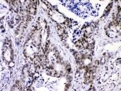 IHC testing of FFPE human intestinal cancer with hnRNP F antibody at 1ug/ml. HIER: steam section in pH6 citrate buffer for 20 min.