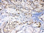 Hepatitis B Virus Antibody Human Liver Cancer IHC. Immunohistochemistry testing of FFPE human liver cancer tissue with Hepatitis B Virus antibody at 0.5ug/ml. HIER: steam section in pH6 citrate buffer for 20 min and allow to cool prior to testing.