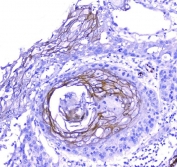 IHC testing of FFEP human esophagus squama cancer tissue with Periplakin antibody. Required HIER: steam section in pH8 EDTA for 20 min and allow to cool prior to testing.