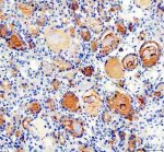 PDE5A Antibody Human Thyroid Cancer IHC. Immunohistochemistry was performed on paraffin-embedded human thyroid cancer tissue using PDE5A Antibody at 2 ug/mL. Heat-induced epitope retrieval was carried out in pH 8 EDTA buffer, and the tissue was incubated with the primary antibody overnight at 4Â°C. Bound antibody was detected using an HRP-conjugated goat anti-rabbit IgG secondary antibody with DAB chromogen. Distinct cytoplasmic staining is observed in the thyroid carcinoma cells, consistent with PDE5A expression, while surrounding stromal elements exhibit comparatively low background staining. These results demonstrate that this cGMP Specific Phosphodiesterase Antibody is suitable for immunohistochemical detection of PDE5A in formalin-fixed, paraffin-embedded human thyroid cancer tissue.