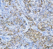IHC staining of FFPE human non-small cell lung cancer tissue with AGR2 antibody. HIER: boil tissue sections in pH8 EDTA for 20 min and allow to cool before testing.