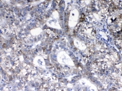 HER2 Antibody Liver Cancer IHC. Immunohistochemistry testing of FFPE human liver cancer tissue with HER2 antibody. Required HIER: steam section in pH6 citrate buffer for 20 min and allow to cool prior to testing.