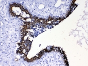 Cytokeratin 8 Antibody Breast Cancer IHC. Immunohistochemical staining of FFPE human breast cancer tissue using Cytokeratin 8 Antibody at 1 Âµg/ml demonstrates strong membranous and cytoplasmic HRP-DAB brown staining within malignant epithelial cells lining glandular and duct-like tumor structures. The staining pattern is consistent with expression of Cytokeratin 8 (CK8/KRT8), a type II intermediate filament protein widely expressed in simple epithelial tissues and epithelial-derived carcinomas. Cytokeratin 8 immunoreactivity highlights neoplastic epithelial cell populations and supports evaluation of epithelial differentiation and tumor-associated architecture in breast cancer specimens. Required HIER: steam tissue sections in pH 6 citrate buffer for 20 minutes and allow to cool prior to testing.