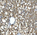 Cytokeratin 8 Antibody Human Kidney Cancer IHC. Immunohistochemical staining of FFPE human kidney cancer tissue using Cytokeratin 8 Antibody / KRT8 Antibody at 2 ug/ml. Heat-induced epitope retrieval was performed using pH8 EDTA buffer, followed by HRP-conjugated secondary antibody detection and DAB chromogen. Strong membranous and cytoplasmic staining is observed throughout the tumor cells, consistent with the expected localization of Cytokeratin 8. This Cytokeratin 8 Antibody, also called KRT8 Antibody, is suitable for studies of epithelial differentiation, intermediate filament organization, epithelial tumor biology, and Cytokeratin 8 protein localization.