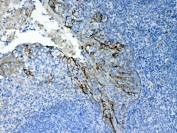 Cytokeratin 8 Antibody Tonsil IHC. Immunohistochemical staining of FFPE human tonsil tissue using Cytokeratin 8 Antibody at 1 Âµg/ml demonstrates distinct membranous and cytoplasmic HRP-DAB brown staining within epithelial cell populations, while the surrounding lymphoid-rich regions remain largely negative. The staining pattern is consistent with expression of Cytokeratin 8 (CK8/KRT8), a type II intermediate filament protein expressed in simple epithelial tissues but not typically in lymphoid cells. Cytokeratin 8 immunoreactivity highlights epithelial structures within the tonsil and supports identification of epithelial differentiation in complex tissue specimens. Required HIER: steam tissue sections in pH 6 citrate buffer for 20 minutes and allow to cool prior to testing.