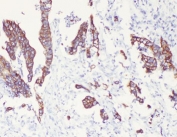 Cytokeratin 8 Antibody Intestinal Cancer IHC. Immunohistochemical staining of FFPE human intestinal cancer tissue using Cytokeratin 8 Antibody at 1 Âµg/ml demonstrates strong membranous and cytoplasmic HRP-DAB brown staining within malignant epithelial cells forming glandular and tumor-associated epithelial structures. The staining pattern is consistent with expression of Cytokeratin 8 (CK8/KRT8), a type II intermediate filament protein widely expressed in simple epithelial tissues and epithelial-derived carcinomas. Cytokeratin 8 immunoreactivity highlights neoplastic epithelial differentiation and tumor architecture, supporting its utility as an epithelial lineage marker in intestinal cancer specimens. Required HIER: steam tissue sections in pH 6 citrate buffer for 20 minutes and allow to cool prior to testing.