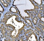 Cytokeratin 8 Antibody Human Thyroid Cancer IHC. Immunohistochemical staining of FFPE human thyroid cancer tissue using Cytokeratin 8 Antibody / KRT8 Antibody at 2 ug/ml. Heat-induced epitope retrieval was performed using pH8 EDTA buffer, followed by HRP-conjugated secondary antibody detection and DAB chromogen. Strong membranous and cytoplasmic staining is observed throughout the glandular tumor epithelium, consistent with the expected localization of Cytokeratin 8. This Cytokeratin 8 Antibody, also called KRT8 Antibody, is suitable for studies of epithelial differentiation, intermediate filament organization, epithelial tumor biology, and Cytokeratin 8 protein localization.