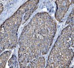 Cytokeratin 8 Antibody Human Liver Cancer IHC. Immunohistochemical staining of FFPE human liver cancer tissue using Cytokeratin 8 Antibody / KRT8 Antibody at 2 ug/ml. Heat-induced epitope retrieval was performed using pH8 EDTA buffer, followed by HRP-conjugated secondary antibody detection and DAB chromogen. Strong membranous and cytoplasmic staining is observed throughout the tumor cells, consistent with the expected localization of Cytokeratin 8. This Cytokeratin 8 Antibody, also called KRT8 Antibody, is suitable for studies of epithelial differentiation, intermediate filament organization, epithelial tumor biology, and Cytokeratin 8 protein localization.