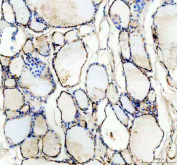 IHC analysis of TSH Receptor Antibody / TSHR. TSH Receptor expression was examined in a paraffin-embedded section of human thyroid cancer tissue. Following heat-mediated antigen retrieval in EDTA buffer (pH 8.0), tissue sections were blocked with goat serum and incubated with a rabbit anti-TSH Receptor antibody. Immunoreactivity was visualized using an HRP-based detection system with DAB chromogen. Staining is primarily observed along the membranes of thyroid follicular epithelial cells, with additional cytoplasmic signal consistent with receptor synthesis and intracellular trafficking.
