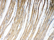 IHC testing of FFPE human intestinal cancer tissue with GJC1 antibody at 1ug/ml. Required HIER: steam section in pH6 citrate buffer for 20 min and allow to cool prior to testing.
