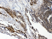 STAT1 Antibody Intestinal Cancer IHC. Immunohistochemistry staining of FFPE human intestinal cancer tissue using STAT1 antibody demonstrates strong cytoplasmic and nuclear staining within neoplastic epithelial cell populations, consistent with expression of Signal Transducer and Activator of Transcription 1 (STAT1). STAT1 is a key transcription factor within the JAK-STAT signaling pathway that mediates cellular responses to interferons, cytokines, and other extracellular signaling molecules. The observed staining pattern is consistent with the role of STAT1 in regulating transcriptional programs involved in immune responses, cellular signaling, differentiation, and tumor-associated signaling networks. These findings support the utility of STAT1 antibody for studies of signal transduction, immune regulation, and transcription factor expression in human tissues. Required HIER: steam section in pH6 citrate buffer for 20 min and allow to cool prior to testing.