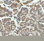 Immunohistochemical staining of FFPE human lung cancer tissue with ECE1 antibody, HRP-secondary and DAB substrate. HIER: boil tissue sections in pH8 EDTA for 20 min and allow to cool before testing.
