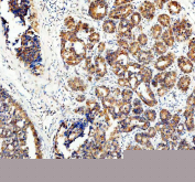 Immunohistochemical staining of FFPE human breast cancer tissue with ECE1 antibody, HRP-secondary and DAB substrate. HIER: boil tissue sections in pH8 EDTA for 20 min and allow to cool before testing.