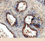 ALDH1A3 Antibody Prostate Cancer IHC. Immunohistochemistry staining of FFPE human prostate cancer tissue using ALDH1A3 antibody with HRP-secondary and DAB chromogen demonstrates strong cytoplasmic staining within neoplastic glandular epithelial cells, consistent with expression of Aldehyde Dehydrogenase 1 Family Member A3 (ALDH1A3). Also known as retinaldehyde dehydrogenase 3 (RALDH3), ALDH1A3 is an NAD-dependent enzyme involved in retinoic acid synthesis and regulation of cellular differentiation pathways. The observed staining pattern is consistent with the established role of ALDH1A3 in retinoid metabolism, tissue homeostasis, and cancer-associated cellular plasticity. These findings support the utility of ALDH1A3 antibody for studies of tumor biology, stem cell-associated pathways, and differentiation-related signaling mechanisms. HIER: boil tissue sections in pH 8 EDTA for 20 min and allow to cool before testing.