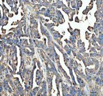 CD151 Antibody Human Ovarian Cancer IHC. Immunohistochemical staining of FFPE human ovarian cancer tissue using CD151 Antibody following heat-induced epitope retrieval in pH8 EDTA buffer. The tissue was incubated with the primary antibody at 2 ug/ml and detected using an HRP-conjugated secondary antibody with DAB chromogen. CD151 immunoreactivity is observed predominantly along the cell membrane with additional cytoplasmic staining in the neoplastic epithelial cells, consistent with the known localization of this tetraspanin family member. These findings demonstrate that this CD151 Antibody, a Tetraspanin Cell Adhesion Protein Antibody, is suitable for immunohistochemical detection of endogenous CD151 in FFPE human ovarian cancer tissue.