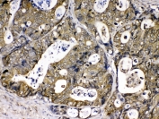 Cyclophilin A Antibody Intestinal Cancer IHC. Immunohistochemical staining of FFPE human intestinal cancer tissue using Cyclophilin A Antibody / Protein Folding Chaperone Antibody demonstrates strong cytoplasmic HRP-DAB brown staining within malignant epithelial cells. The staining pattern is consistent with expression of Cyclophilin A (PPIA), a peptidyl-prolyl cis-trans isomerase that functions as a molecular chaperone involved in protein folding, cellular stress responses, and signal transduction. Positive immunoreactivity throughout the tumor cell population highlights the widespread expression of Cyclophilin A in metabolically active cells and supports its role in maintaining protein homeostasis under conditions of rapid growth and cellular remodeling. Required HIER: steam section in pH6 citrate buffer for 20 min and allow to cool prior to testing.