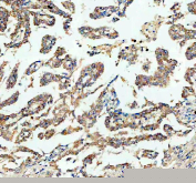IHC staining of FFPE human lung cancer tissue with Bax antibody, HRP-labeled secondary and DAB substrate. HIER: boil tissue sections in pH8 EDTA for 20 min and allow to cool before testing.