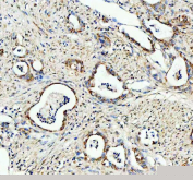 Bcl-XL Antibody Pancreatic Cancer IHC. Immunohistochemistry staining of FFPE human pancreatic cancer tissue using Bcl-XL Antibody / Anti-Apoptotic Protein Antibody demonstrates cytoplasmic and membranous HRP-DAB brown staining within malignant epithelial cells forming glandular tumor structures. The staining pattern is consistent with expression of Bcl-XL, the major anti-apoptotic protein encoded by the BCL2L1 gene. Bcl-XL functions as a key regulator of mitochondrial apoptosis by inhibiting pro-apoptotic BCL2 family members and promoting cellular survival under conditions of stress. Expression of Bcl-XL is frequently investigated in cancer biology due to its association with tumor cell survival, apoptosis resistance, and therapeutic response. HIER was performed by boiling tissue sections in pH 8 EDTA buffer for 20 minutes followed by cooling prior to immunostaining. HRP-conjugated secondary antibody and DAB chromogen were used for signal detection.