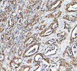 HFE Antibody Human Pancreatic Cancer IHC. Immunohistochemical analysis of FFPE human pancreatic cancer tissue following heat-induced epitope retrieval in pH8 EDTA buffer. Tissue sections were incubated with HFE Antibody at 2 ug/ml overnight, followed by an HRP-conjugated secondary antibody and DAB chromogen for visualization. Moderate membranous and cytoplasmic staining is observed in the neoplastic epithelial cells, consistent with the localization of HFE as a membrane-associated regulator of iron homeostasis. This staining pattern demonstrates that this HFE Antibody, a Hereditary Hemochromatosis Protein Antibody, is suitable for detecting endogenous HFE expression in human FFPE pancreatic cancer tissue by immunohistochemistry.