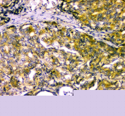 Immunohistochemical staining using NARG1 antibody on paraffin-embedded human gastric cancer tissue sections. Heat-induced epitope retrieval was performed using EDTA buffer (pH 8.0) prior to antibody incubation. Sections were blocked with 10% goat serum and incubated with NARG1 antibody overnight at 4C. Detection was carried out using an HRP-based secondary system with DAB as the chromogen. Staining demonstrates cytoplasmic immunoreactivity in tumor cells. Nuclei were counterstained with hematoxylin.