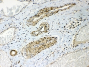 HSP22 Antibody Human Lung Cancer IHC. Immunohistochemistry staining of FFPE human lung cancer tissue with HSP22 Antibody at 1 ug/ml. HIER was performed by steaming tissue sections in pH 6 citrate buffer for 20 minutes prior to staining. The tissue section was incubated with HSP22 antibody, followed by HRP-conjugated secondary antibody and DAB chromogen detection. HSP22 Antibody / Small Heat Shock Protein Antibody demonstrates cytoplasmic staining in lung cancer cells and supports studies of HSPB8 expression, molecular chaperone activity, protein quality control and cellular stress response pathways.