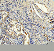Immunohistochemical staining of FFPE human lung cancer tissue with ANGPTL2 antibody, HRP-secondary and DAB substrate. HIER: boil tissue sections in pH8 EDTA for 20 min and allow to cool before testing.
