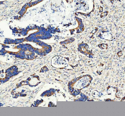 Immunohistochemical staining of FFPE human colon cancer tissue with ANGPTL2 antibody, HRP-secondary and DAB substrate. HIER: boil tissue sections in pH8 EDTA for 20 min and allow to cool before testing.