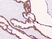 Beta-Catenin Antibody Breast Cancer Tissue IHC. Immunohistochemistry analysis of FFPE human breast cancer tissue using Beta-Catenin antibody shows strong membranous staining outlining tumor epithelial cells, consistent with CTNNB1 / Catenin beta-1 localization at adherens junctions, with mild cytoplasmic signal in select cells. Tumor glandular structures are clearly defined, while surrounding stromal regions display comparatively low staining. Hematoxylin counterstain provides nuclear contrast and tissue architecture. HIER: steam FFPE sections in pH 6 citrate buffer for 20 min and allow to cool prior to testing.