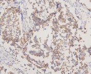 EGFR Antibody Human Glioma IHC. Immunohistochemistry staining of FFPE human glioma with EGFR antibody. HIER: boil tissue sections in pH6, 10mM citrate buffer, for 20 min and allow to cool before testing.