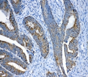 IHC testing of FFPE human colon cancer tissue with FH antibody at 1ug/ml. Required HIER: steam section in pH6 citrate buffer for 20 min and allow to cool prior to testing.