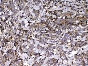 VDBP Antibody Lung Cancer IHC. Immunohistochemistry analysis of FFPE human lung cancer tissue stained with VDBP antibody demonstrates diffuse granular cytoplasmic HRP-DAB brown staining throughout tumor-associated epithelial cellular populations, consistent with the role of Vitamin D binding protein / VDBP in circulating transport physiology and systemic metabolic regulation pathways. The observed staining profile aligns with the secretory biology of this vitamin D-associated carrier protein. Required HIER: steam tissue sections in pH 6 citrate buffer for 20 min and allow to cool prior to testing.