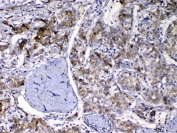 VDBP Antibody Liver Cancer IHC. Immunohistochemistry analysis of FFPE human liver cancer tissue stained with VDBP antibody demonstrates granular cytoplasmic HRP-DAB brown staining within tumor-associated hepatic epithelial cellular populations, consistent with expression of Vitamin D binding protein / VDBP in hepatic secretory and serum transport-associated pathways. The observed staining pattern aligns with the biologic role of VDBP as a circulating carrier protein involved in vitamin D metabolism and endocrine homeostasis. Required HIER: steam tissue sections in pH 6 citrate buffer for 20 min and allow to cool prior to testing.